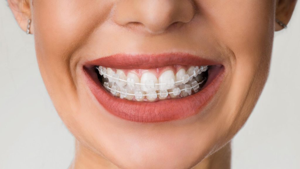 Zâmbetul care strălucește: De ce să alegi un aparat dentar safir pentru corecția danturii (P)