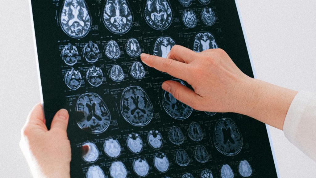 Afecțiuni ale creierului tot mai frecvente în România. Ce semnal de alarmă trag medicii