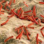 Autoritățile din Cluj spun că au sub control situația cazurilor de lepră: „Nu există un risc major pentru populație”