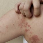 Ce trebuie să știi despre lepră: cum se transmite și ce simptome are? A revenit în România după 44 de ani