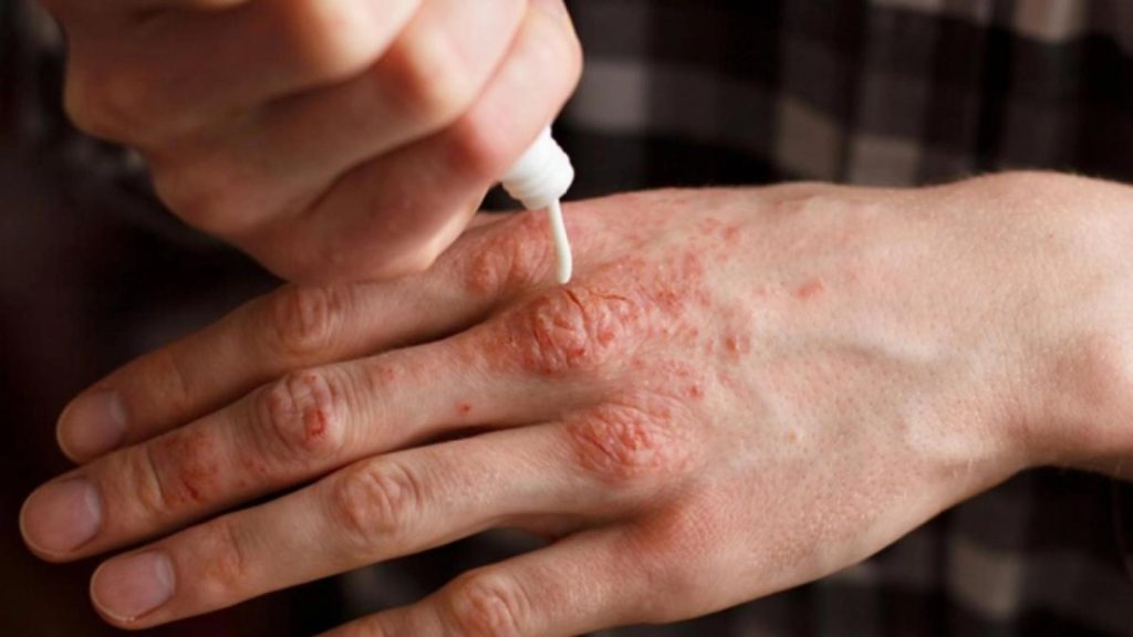 Alertă extinsă de lepră la centrul SPA din Cluj: 2.000 de clienți rugați să meargă la medic