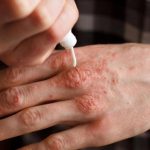 Alertă extinsă de lepră la centrul SPA din Cluj: 2.000 de clienți rugați să meargă la medic