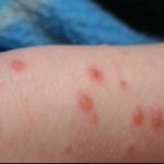 Rujeola revine în forță. Creștere alarmantă într-o țară UE, autoritățile dau vina pe România și Maroc