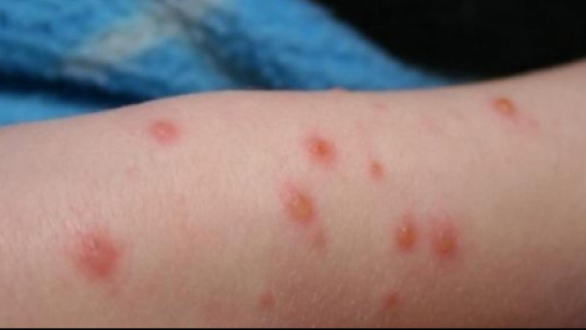 Rujeola revine în forță. Creștere alarmantă într-o țară UE, autoritățile dau vina pe România și Maroc