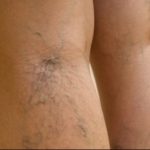 Planta care te scapă de varice. Rețeta recomandată de fitoterapeuți